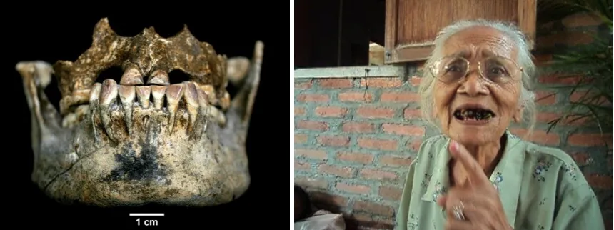 Gambar 10. Jejak mengunyah sirih pada gigi (kiri), dan tradisi mengunyah sirih pada etnik Jawa (kanan) 