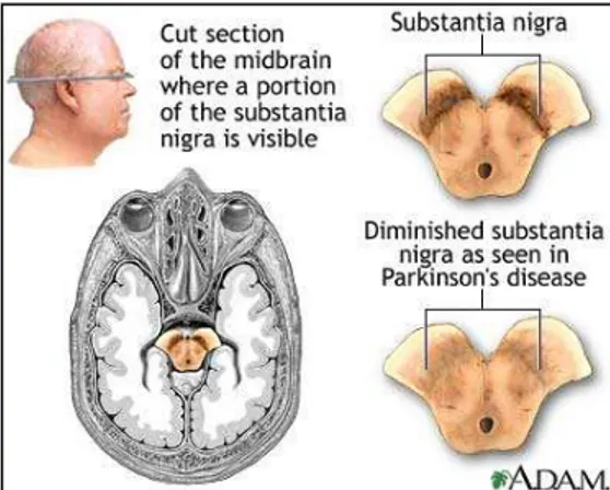 Gambar 3. 8: Degenerasi substansia nigra pada penyakit Parkinson  Gejala penyakit Parkinson 