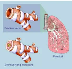 Gambar 6. 1: Kondisi bronkus pada keadaan sehat dan peradangan (bronkitis).  Emfisema  paru  (pengembangan)berciri  sesak  napas  terus  menerus  yang  menghebat  pada  waktu  mengeluarkan  tenaga  dan  seringkali  dengan  perasaan  letih  dan  tidak  berg