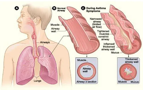 Gambar 6. 3: Kondisi saluran pernafasan normal dan pada kondisi asma. 