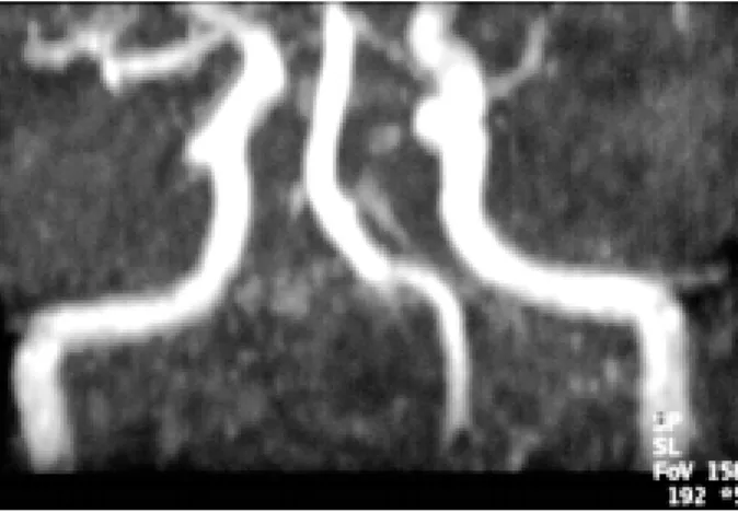 Fig. 1. A 74-year-old female patient with right frontotemporal headache, vertigo, nausea and vomiting, ataxia: (a) transverse T2W image: acute ischemia in the right posterior inferior  cere-bellar artery territory involving dorsolateral medulla  oblonga-ta