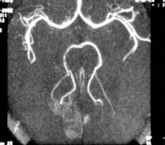Fig. 5. A 51-year-old male patient with sudden weakness, verti- verti-go, nausea, nystagmus, astasia-abasia: (a) transverse  diffusion-weighted image,