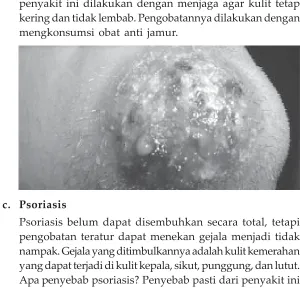 Gambar 1.8Ringworm