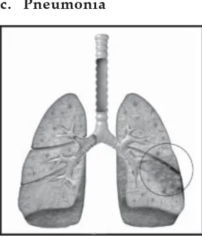 Gambar 1.11Pneumonia