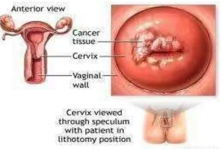 Gambar 2.1 Morfologi serviks yang terserang HPV (Anonim, 2013) 