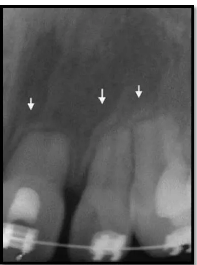 Gambar 3. Resorpsi akar yang khas  akibat tekanan ortodonti pada apikal akar18  