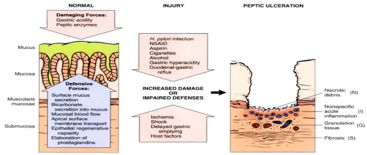 Gambar 2.1.Faktor-faktor penyebab ulkus (Liu dan Crawford, 2005) 
