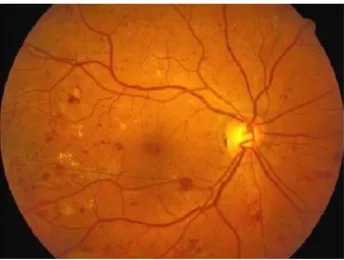Gambar  2.2  Standar  fotografi  ETDRS  menunjukkan  perdarahan  retina  dan  mikroaneurisma  [15]