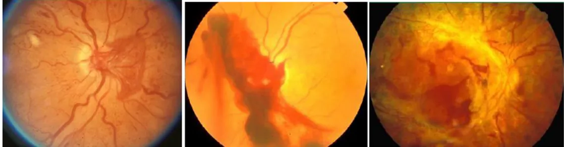 Gambar 2.4 Fotografi fundus berwarna RDP yang menunjukkan neovaskularisasi,  perdarahan neovaskularisasi, pelepasan retina dari makula [15]