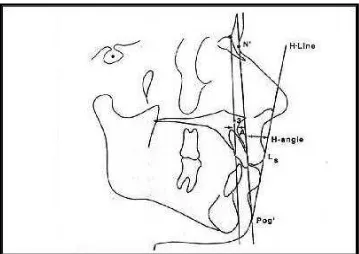 Gambar 11. Analisa jaringan lunak wajah menurut Holdaway (H angle).4 