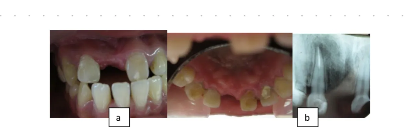 Gambar 5. a) Gigi 12 pasca restorasi (gambaran klinis), b) Gigi 12 pasca restorasi  (gambaran radiografis) 