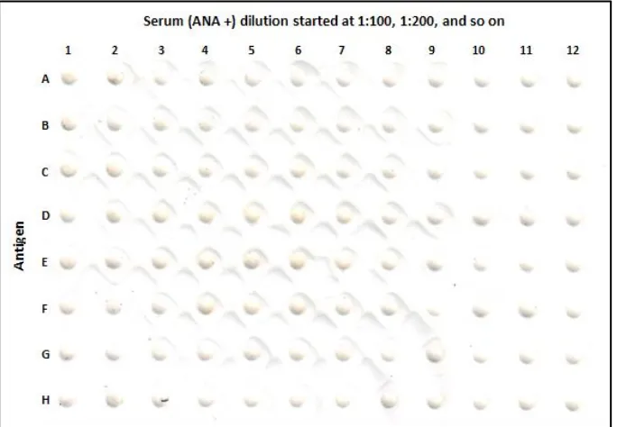 Figure 1. Checkerboard test results of nuclear protein antigens derived from leukocytes and antibodies obtained from the serum of a SLE patient with high ANA levels.