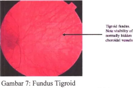 Gambar 7: Fundus T i g r o i d Sumber: Duane's Ophalmology, 2 0 0 6 