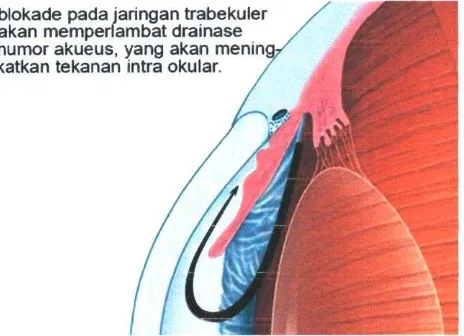 Gambar 1.4 Glaukoma Sudut Tertutup Blokade Pupil 