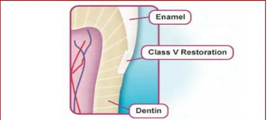 Gambar 1. Restorasi Klas V berada pada enamel dan sebagian lagi pada dentin. 