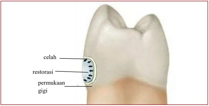 Gambar 7.  2.6.1Shrinkage polimerisasi menghasilkan celah antara permukaan gigi dengan bahan restorasi.18  Shrinkage Stress 