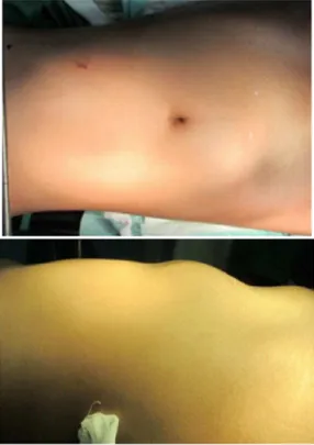 Gambar    1. Tampak  vulnus  ekskoriatum  di abdomen  kuadr an  kiri  atas (panah  putih)