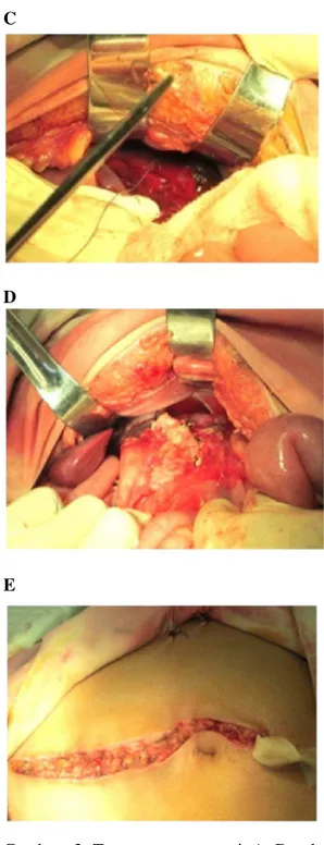 Gambar   2. Temuan saat operasi: A. Darah intr aabdomen  ±1300cc;  B. Sumber perdarahan adalah ruptur lien (panah putih); C