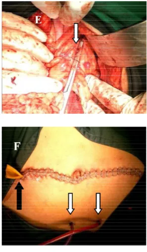 Gambar   5. Temuan saat operasi: A. Darah intr aabdomen  ±1800cc;  B. Blood  clot  dievakuasi  (panah putih);  C