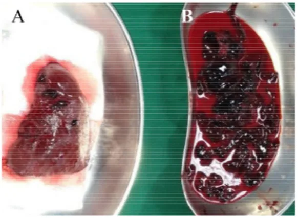 Gambar    6.  Organ  Lien: A.  tampak  ruptur (panah  putih).  B.  Sebagian  darah dan  bekuan  darah  yang  dievakuasi dari intraabdomen.