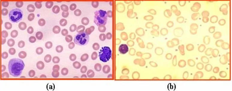 Gambar 1. Perbandingan sel darah merah normal (a) dengan sel darah merah pada anemia defisiensi besi (mikrositik hipokrom) (b) (Crowley, 2001)  