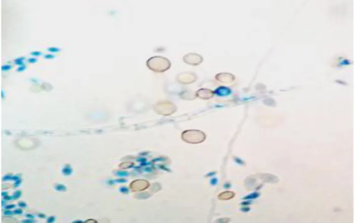 Gambar 1. Kapang kapang Acremonium sp-CBS 3  dengan pewarnaan  menggunakan  lactofenol  cotton  blue  melalui  perbesaran  1000x  dari  hasil isolasi kulit umbi dahlia merah dari Sukabumi pada media PDA  (Susilowati, dkk, 2012)
