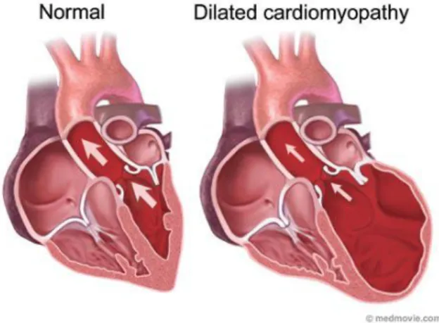 Gambar 1. Jantung normal dibandingkan dengan jantung pasien kardiomiopati dilatasi  10