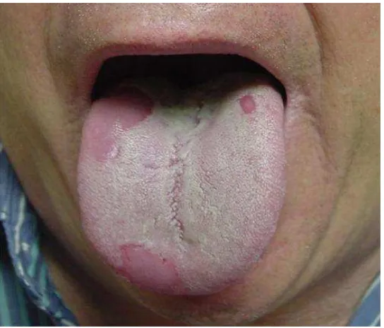 Gambar 3.Geographic tongue pada lidah orang dewasa 