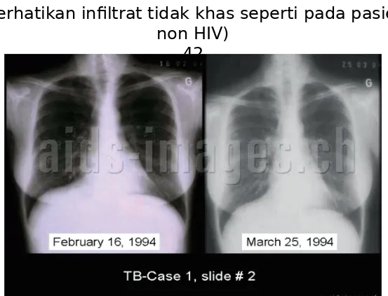 Gambar 2.Gambaran foto toraks TB paru pada 