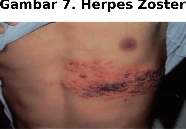 Gambar 7. Herpes Zoster