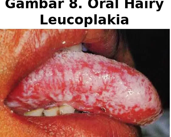 Gambar 8. Oral Hairy 