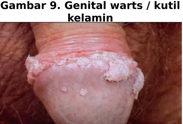 Gambar 9. Genital warts / kutil 