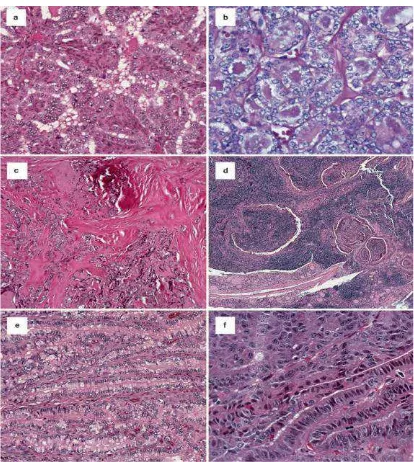 Gambar 2.16.  Varian histopatologik karsinoma papiler tiroid. a. tipe konvensional; b