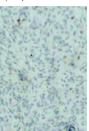 Gambar 3. Beberapa sel tumor meningioma yang menunjukkan pewarnaan p53 