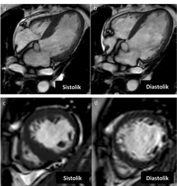 Gambar 5.Tampak hiperintens di mid inferior dan ventrikel  kanan inferoposterior pada pasien inferioposterior IMA­STT2-weighted STIR
