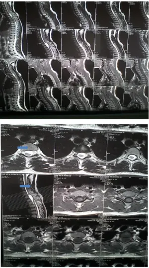 Gambar 2. MRI medula spinalis  