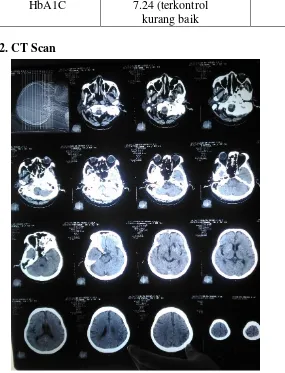 Gambar X. Hasil CT Scan Kepala Tanpa Kontras 