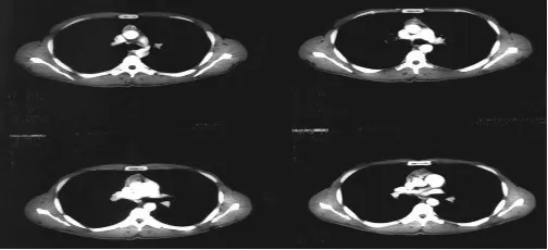 Gambar 6 CT scan othoraks memperlihatkan massa pada bagian anterior mediastinum