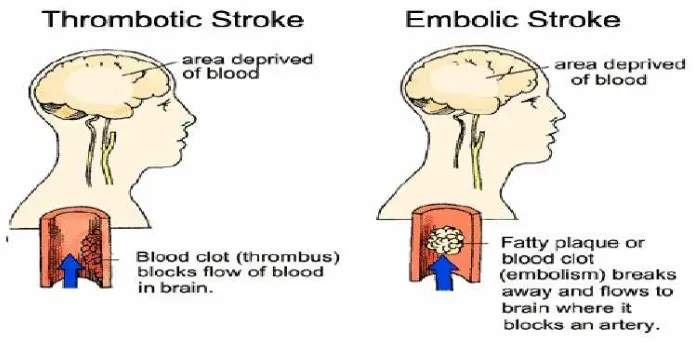 Gambar 1. Patofisiologi stroke iskemik 