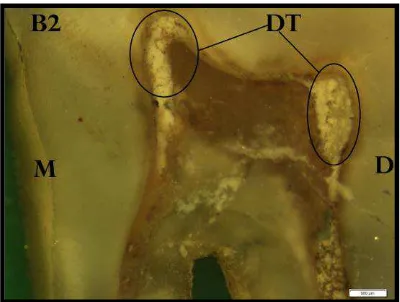 Gambar 7. Dentin tersier akibat menyirih  dengan Microscope Olympus  SZX16 pembesaran 1,25x1000 (Dokumentasi) 