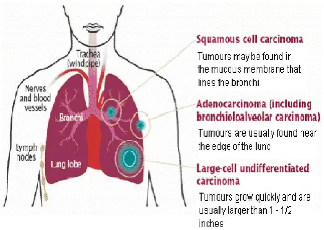 Gambar 2bar 2.1 : Tipe Kanker Paru (Global Lung Cancer Coaloalition)