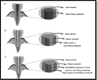 Gambar 2.   Klasifikasi endodontic monoblock berdasarkan jumlah permukaan (A) primary monoblock, (B) secondary monoblock, (C) tertiary monoblock