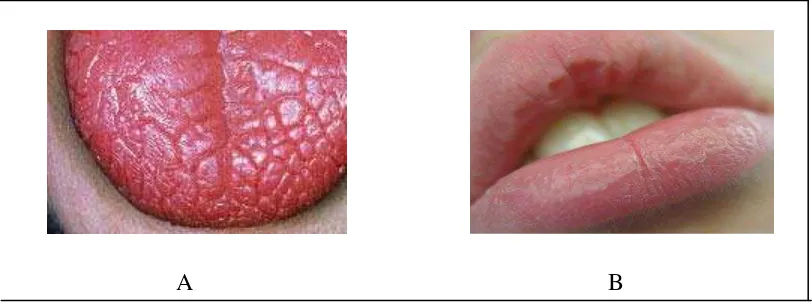 Gambar 1. Tanda Xerostomia. A, lidah berfisura dan berlobul. B, Bibir kering dan pecah-pecah10 