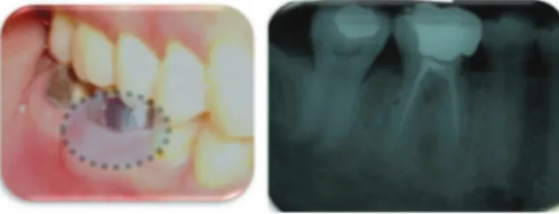 Gambar 4. Foto klinis dan radiografis kasus pasien 2 Review pasca pembedahan