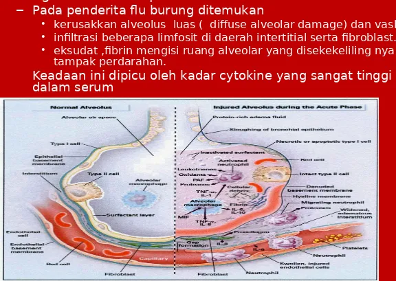 Gambar 3. kerusakan alvioli akibat kadar sitokin yang tinggi 