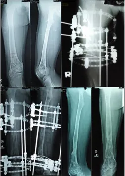 Gambar 7. Kondisi awal Pasien 3 (Tn  W/29 th) dengan severe deformity  (angulasi dan shortening) sebelum  dilakukan koreksi (gambar atas)  menunjukkan hasil yang bagus setelah 