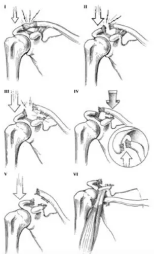 Gambar 1. Klasifikasi cedera sendi  akromioklavikula berdasarkan 