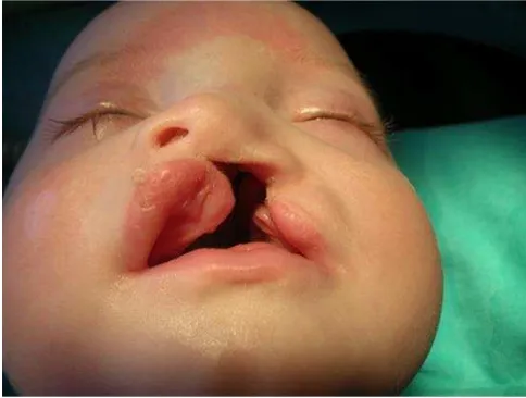 Gambar 1.  Penderita celah bibir unilateral komplit berusia 5 bulan. (Apostol D. The onizuka technique in treating the cleft lip and palate Jurnalul Pediatrului 2008; 11:45-48)14 