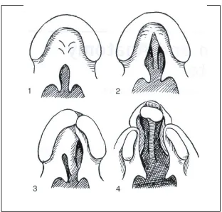 Gambar 7. Klasifikasi celah bibir dan langit-langit menurut Veau.1.Celah dari palatum mole saja.2.Celah dari palatum mole dan palatum durum, meluas ke depan ke foramen insisivus