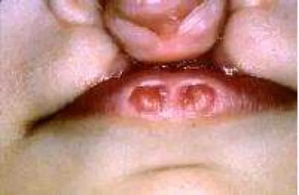 Gambar 4. Penderita celah bibir bilateral dan celah langit-langit dengan van der Woude syndrome dan pit pada bibir bawah.(Conners GP